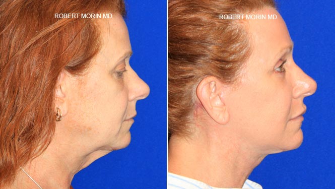 Woman's face, before and after Facelift Surgery treatment, side view, patient 3