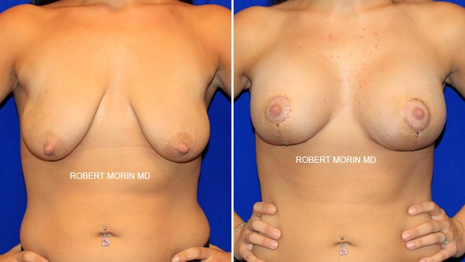 Mastopexy Surgery. Treatment photo - female patient 1