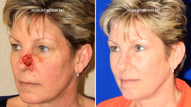 Laser Skin Resurfacing Before & After Photos