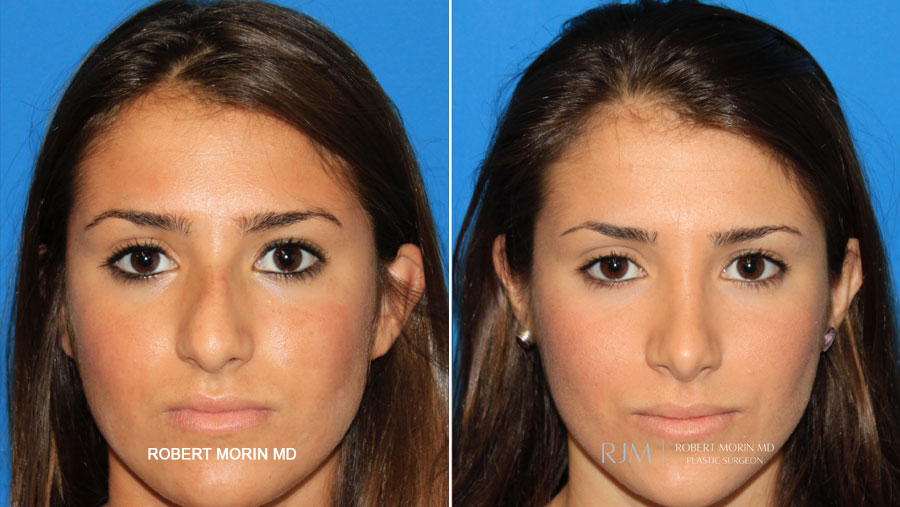 Rhinoplasty - female Before & After Photos