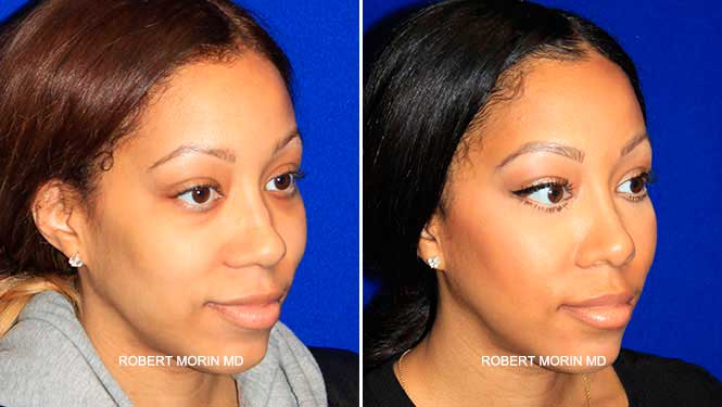 Before & After Woman's face, African American Treatment, oblique view, female patient