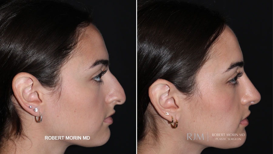 Ultrasonic Rhinoplasty Before & After Photos