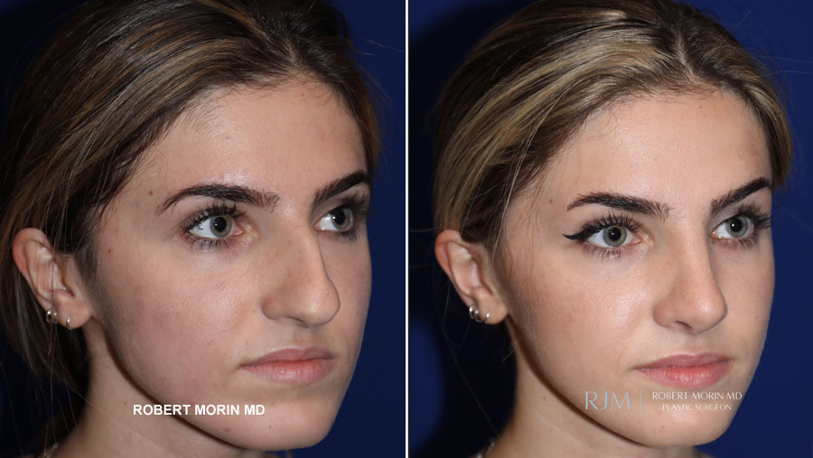 Woman's face, before and after Rhinoplasty treatment, oblique view, patient 4