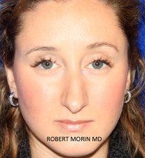 Woman's face, Rhinoplasty Recovery timeline
