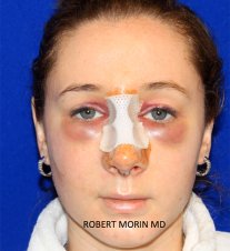 Woman's face, Rhinoplasty Recovery - After 1 day