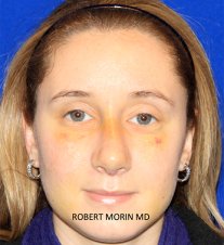 Woman's face, Rhinoplasty Recovery - After 7 days
